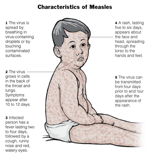 signs and symptoms of measles